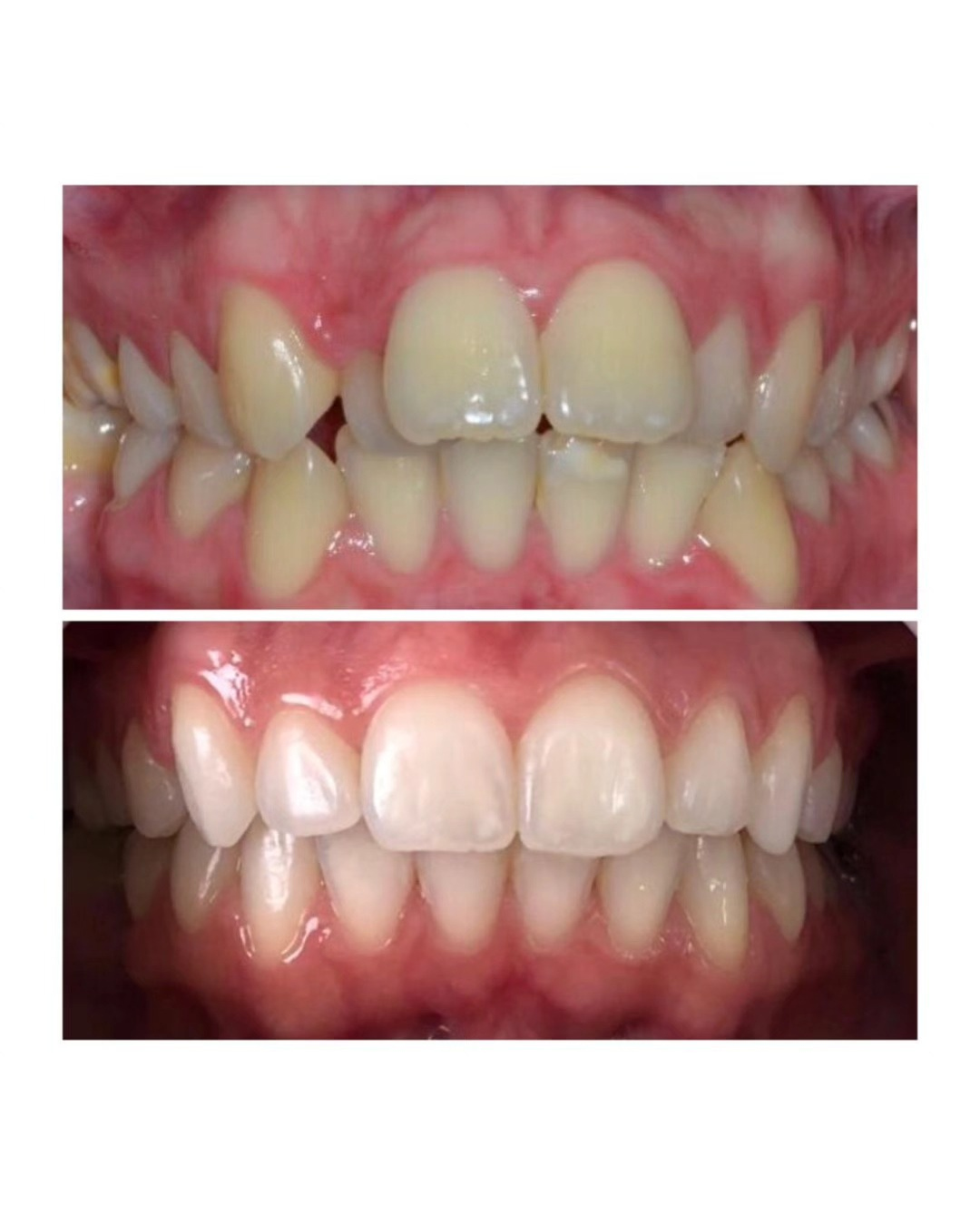 Antes e depois de tratamento ortodôntico — dentes desalinhados e o resultado alinhado